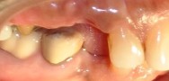 missing teeth area will be restored by dental implant and dental bridge