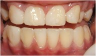 bonding on canines and central incisors to close gaps between teeth 