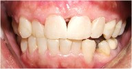 bonding to close gap between front teeth, also change shape of teeth 