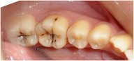 pits and fissures decay on tooth surfaces