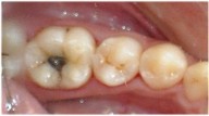 tooth color fillings to replace old metal resoration