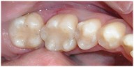 tooth color filling 