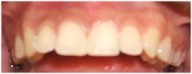 tooth color bonding to close space between teeht