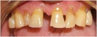 Large gap between teeth , gum receding with root eroding 