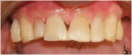 tooth color filling/ bonding to close space between teeth, gum receding, root abfraction