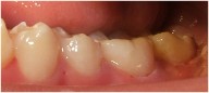 tooth color filling for cavities