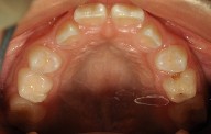 child with narrow arches, need arch development for proper tooth eruption