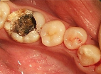 tooth with large gross decay
