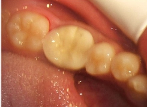 tooth with large gross decay, tooth need crown restoration