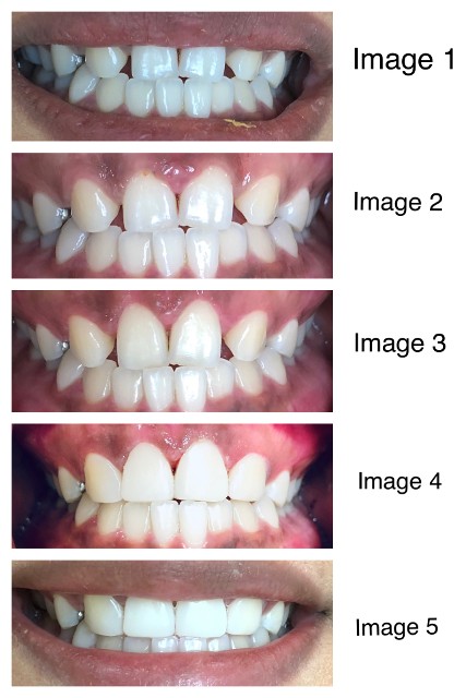 crown lengthening and tooth bonding